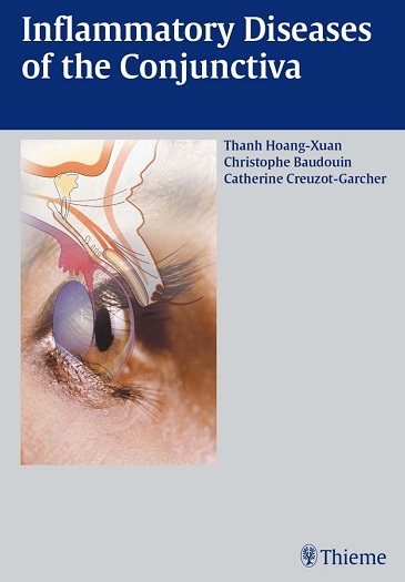 Inflammatory diseases of the conjunctiva